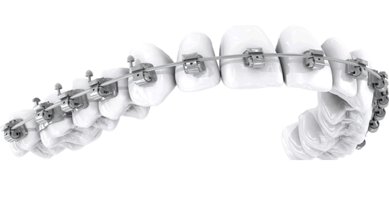 Металлическая самолигирующая брекет-система