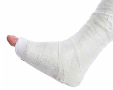Гипсовая повязка перелом лодыжки