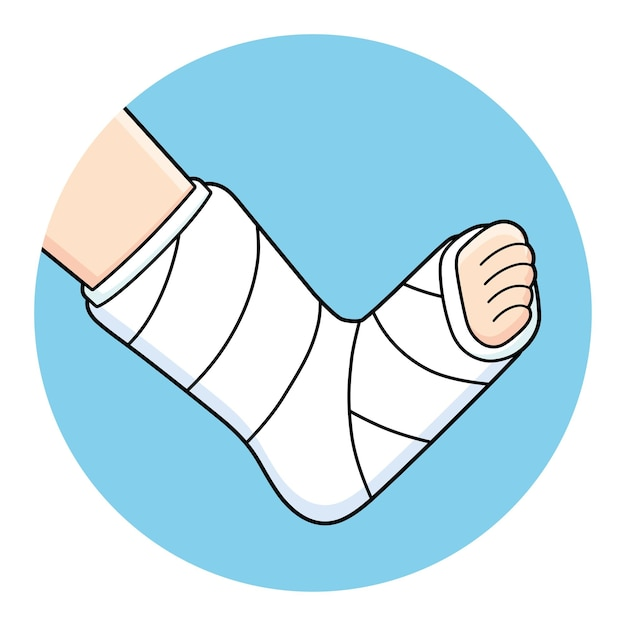 Нога в гипсе на белом фоне