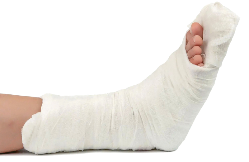 Перелом таранной кости гипсование